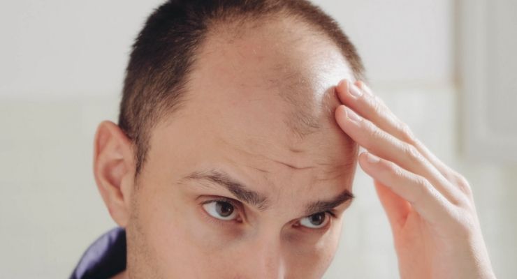 Calvizie: cos'è e fattori di predisposizione