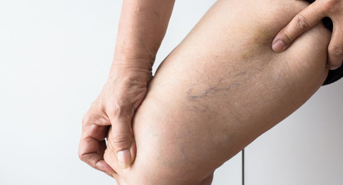 Capillari sulle gambe