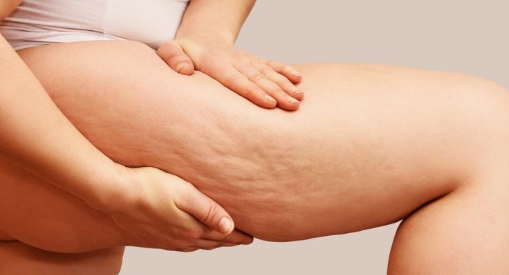 Cellulite: sintomi, cause, cure e rimedi