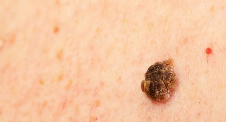 Cheratosi attinica: sintomi, cause e rimedi
