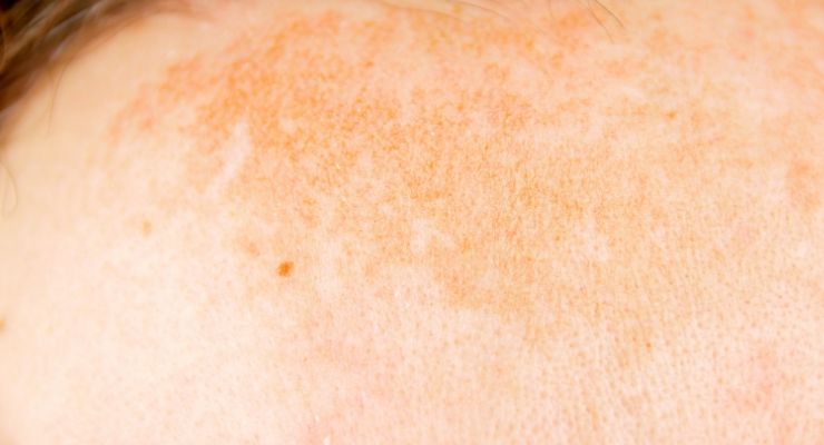 Iperpigmentazioni solari: sintomi, cause e rimedi
