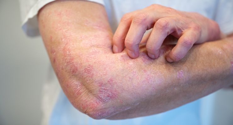 Psoriasi: cos'è, come riconoscerla