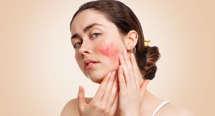 Rosacea: sintomi, cause e rimedi