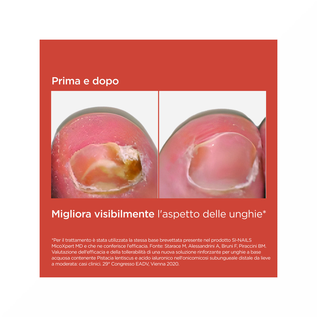 Isdin Si-Nails Micoxpert Md Trattamento Unghie Infezioni Fungine 4,5ml-5
