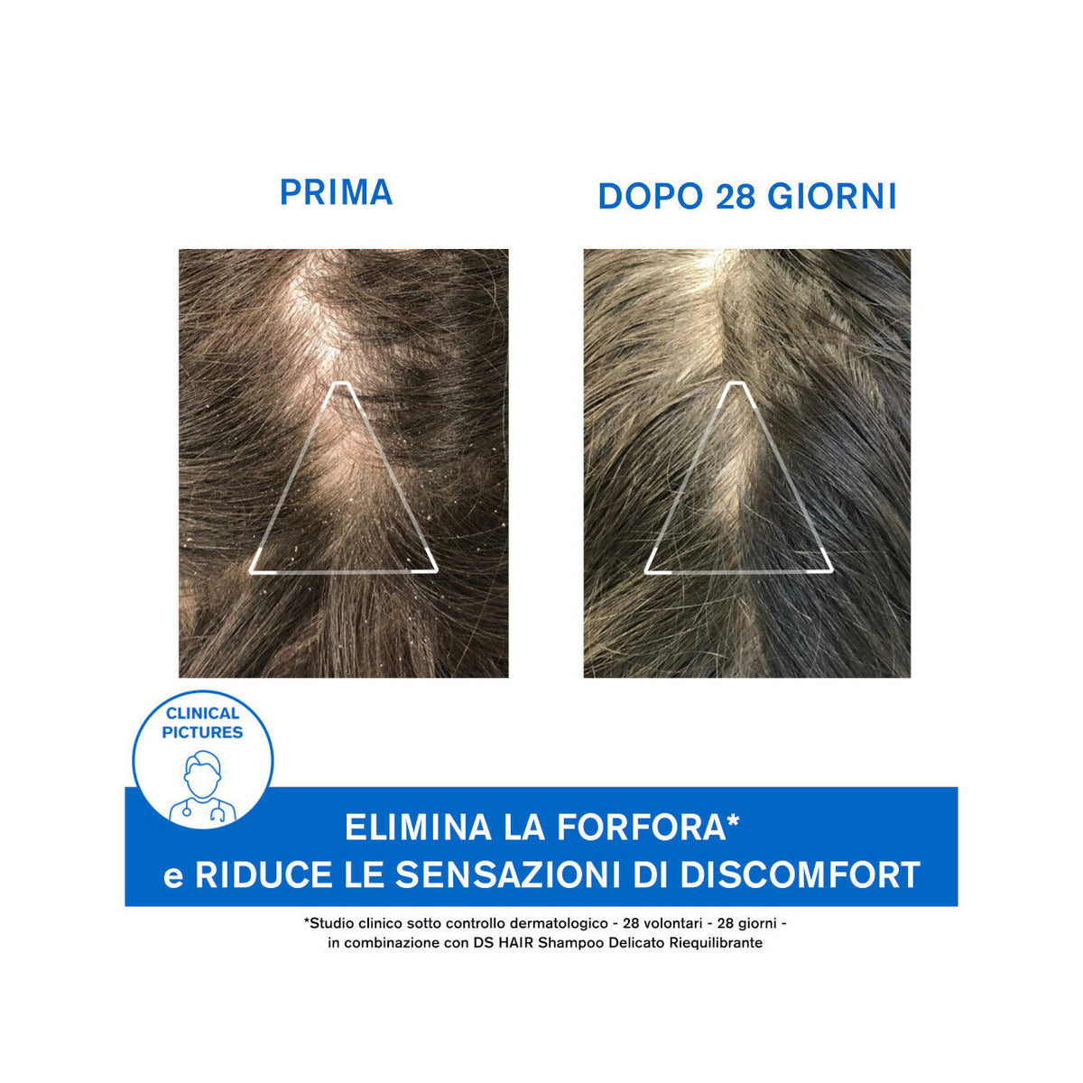 Uriage DS Hair trattamento antiforfora 200ml-9